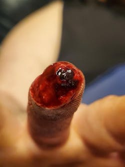 Patrick Walton returned to work right after getting this injury treated. It’s an ugly reminder that shops often value uptime over health. Patrick Walton returned to work right after getting this injury treated. It’s an ugly reminder that shops often value uptime over health.